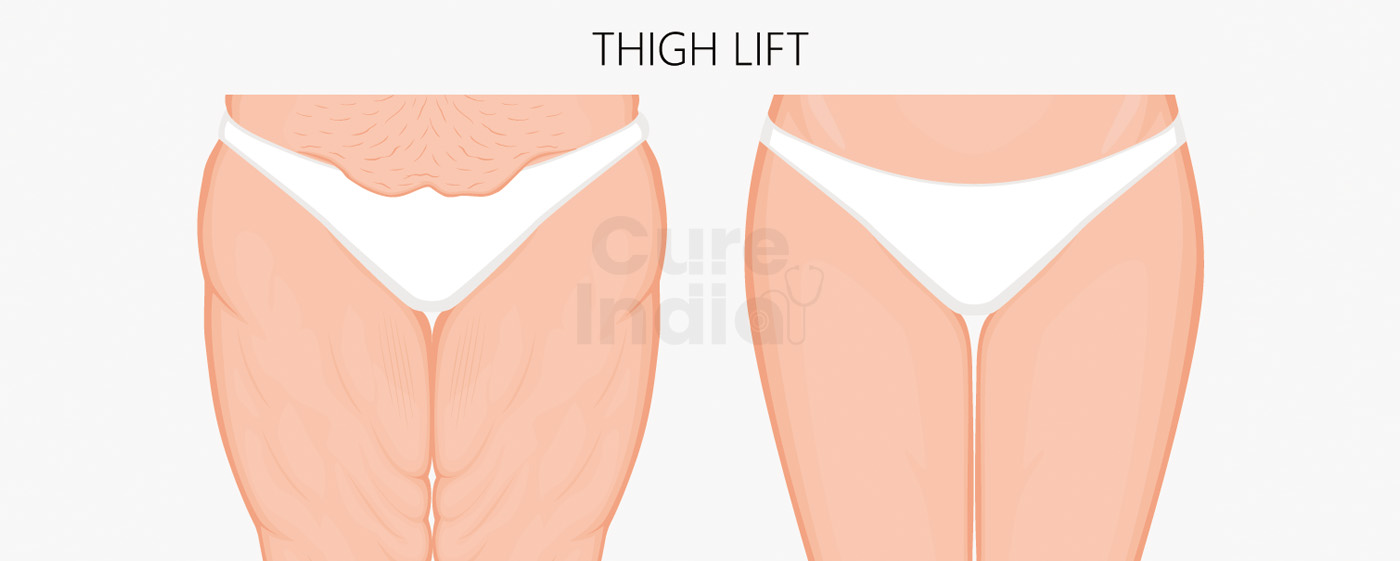 Thigh Lift